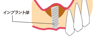 ソケットリフト