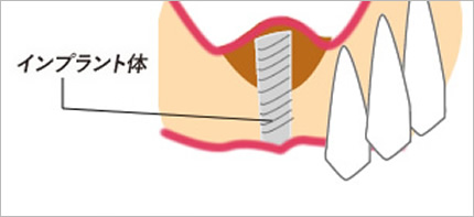 ソケットリフト